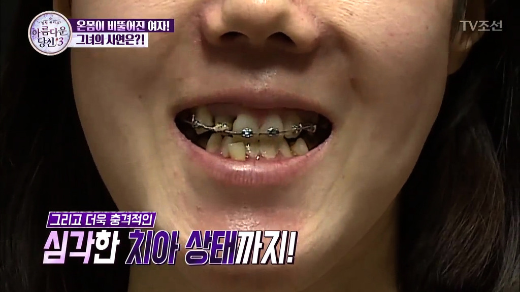 부정교합을 방치하면 안되는 이유 | 인스티즈