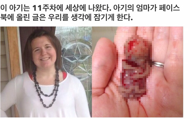 11주만에 세상에 나온 아기(낙태 반대하는 산모 글) (혐오주의) | 인스티즈