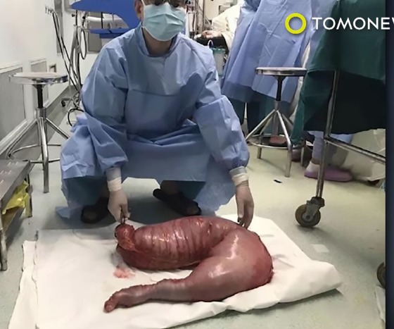 혐주의)변비 걸린 남성의 장을 절제해보니 무게가 13kg | 인스티즈